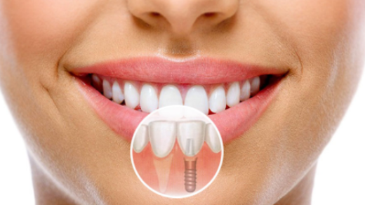 Важливість якісної імплантації зубів