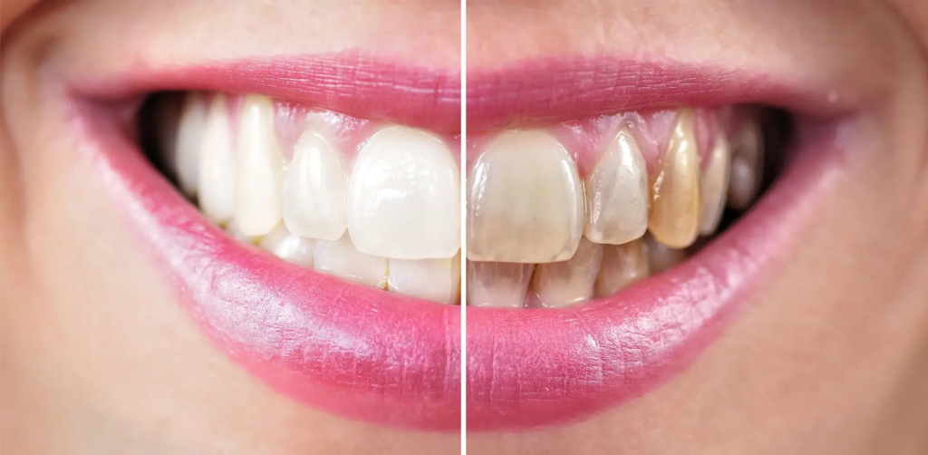 Причини для відбілювання зубів тільки в професійній клініці