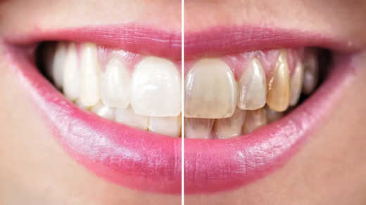 Причини для відбілювання зубів тільки в професійній клініці