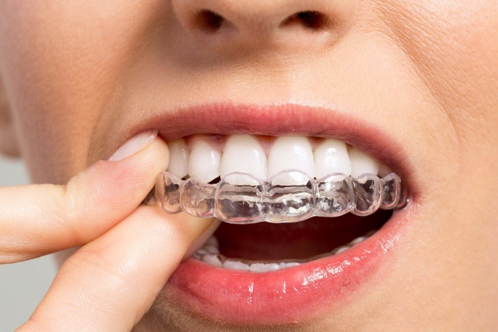 Почему вас могут заинтересовать каппы для выравнивания зубов