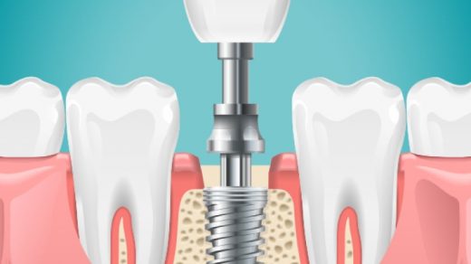 Що таке імплантація зубів